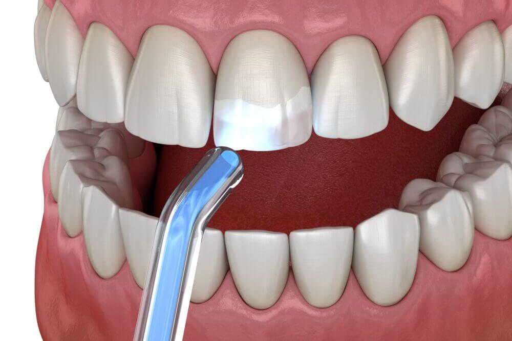Tooth restoration with filling and polymerization lamp. Medically accurate tooth 3D illustration.